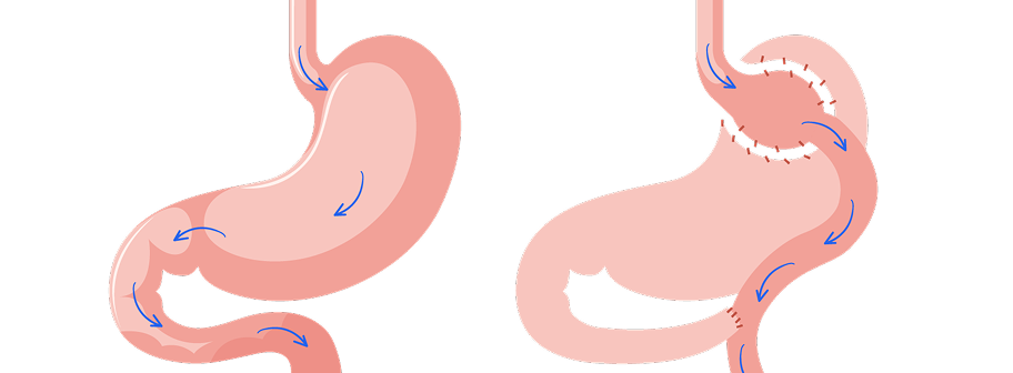 Clínica Gastro ABC - Bypass Gástrico