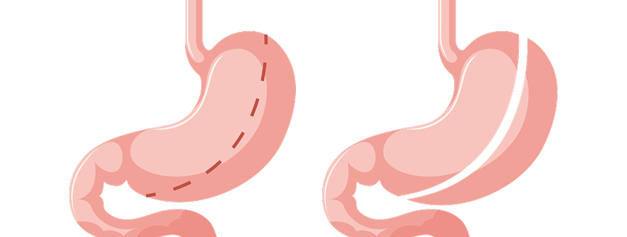 Clínica Gastro ABC - Gastrectomia Vertical